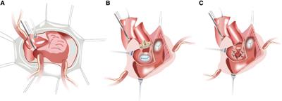 Early outcomes of the “Chimney” commando procedure in the small aortic and mitral annuli